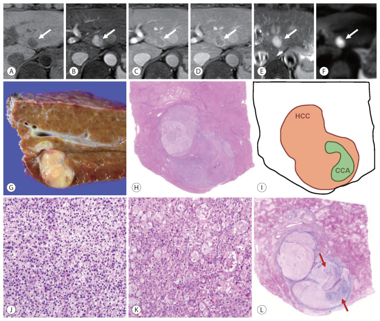 Update on Pathologic and Radiologic Diagnosis of Combined Hepatocellular-Cholangiocarcinoma.