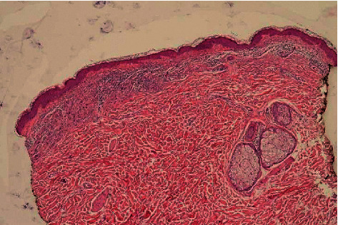 Halo Nevi Are Not Trivial: About 2 Young Patients of Regressed Primary Melanoma That Simulates Halo Nevi.