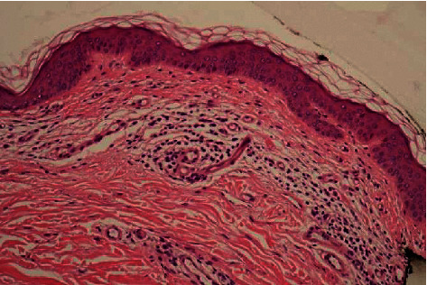 Halo Nevi Are Not Trivial: About 2 Young Patients of Regressed Primary Melanoma That Simulates Halo Nevi.