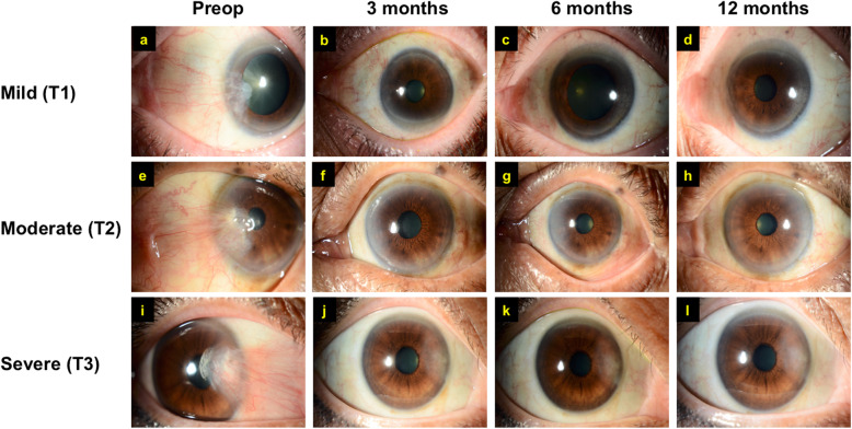 Cosmetic outcome of femtosecond laser-assisted pterygium surgery.