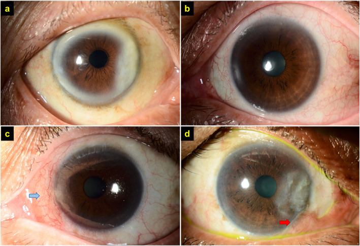 Cosmetic outcome of femtosecond laser-assisted pterygium surgery.