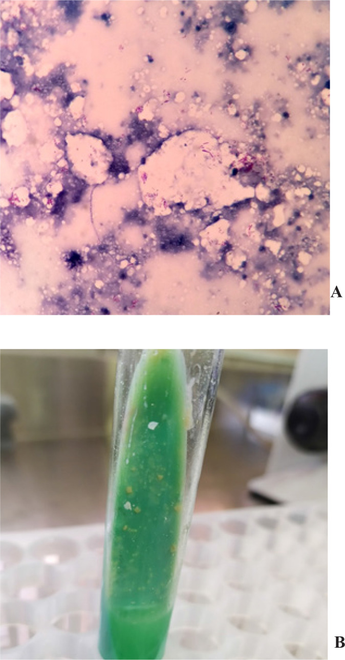 Non-Tuberculous Mycobacterial Pulmonary Disease identified during community-based screening for <i>Mycobacterium Tuberculosis</i>: a case report.