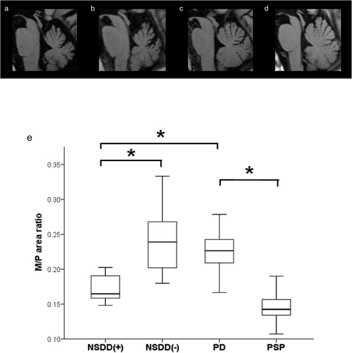 Midbrain atrophy related to parkinsonism in a non-coding repeat expansion disorder: five cases of spinocerebellar ataxia type 31 with nigrostriatal dopaminergic dysfunction.