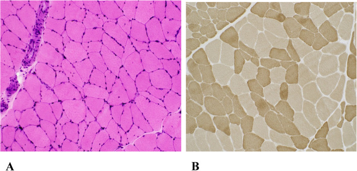 Genetic rhabdomyolysis within the spectrum of the Spinocerebellar Ataxia type 2 responsive to pregabalin.