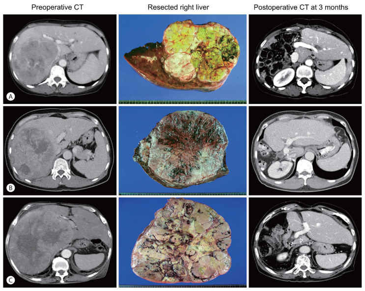 Prediction of Post-resection Prognosis Using the ADV Score for Huge Hepatocellular Carcinomas ≥13 cm.