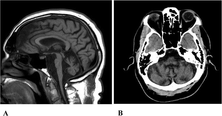 Genetic rhabdomyolysis within the spectrum of the Spinocerebellar Ataxia type 2 responsive to pregabalin.