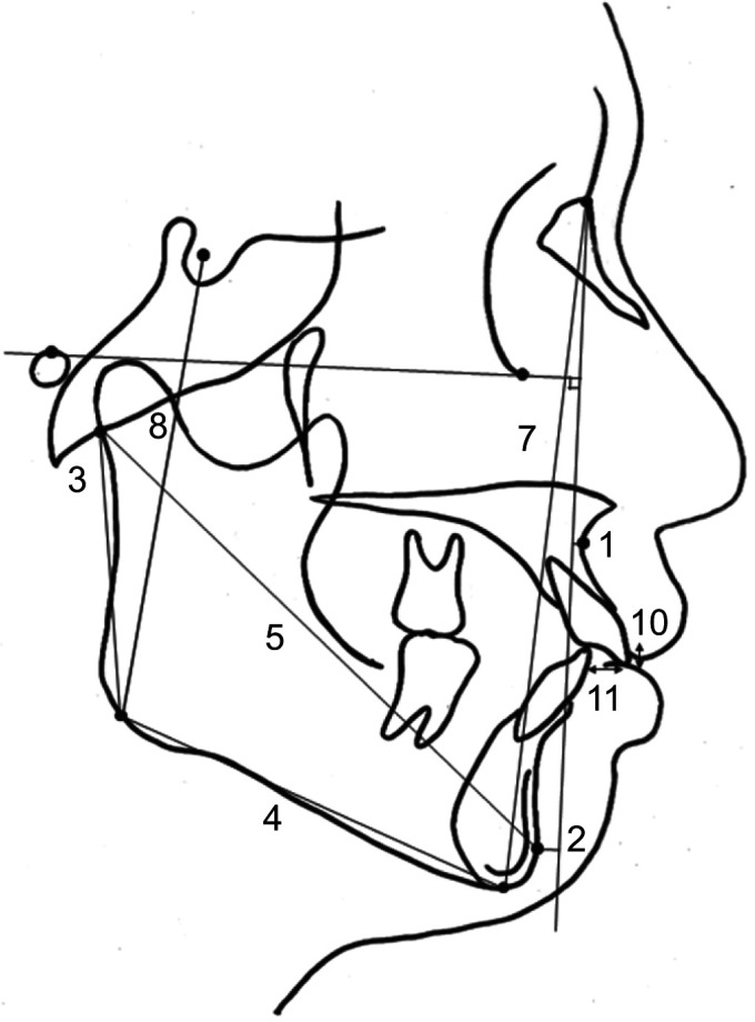 Relationship between rotational disc displacement of the temporomandibular joint and the dentoskeletal morphology.