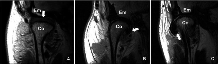 Relationship between rotational disc displacement of the temporomandibular joint and the dentoskeletal morphology.