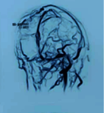 Cerebral Sinus Thrombosis Secondary to SARS-CoV-2 Infection.