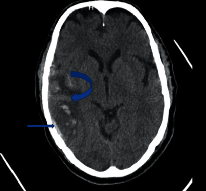 Cerebral Sinus Thrombosis Secondary to SARS-CoV-2 Infection.