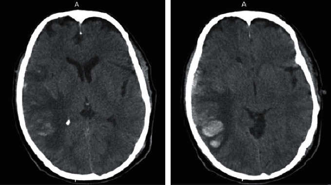 Cerebral Sinus Thrombosis Secondary to SARS-CoV-2 Infection.
