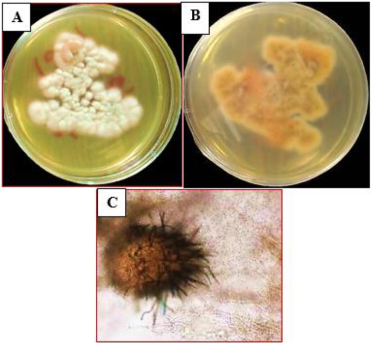 First report of chronic invasive fungal rhinosinusitis in a patient with ovarian cancer caused by <i>Didymella pedeiae</i> and successful treatment with voriconazole: A case report.