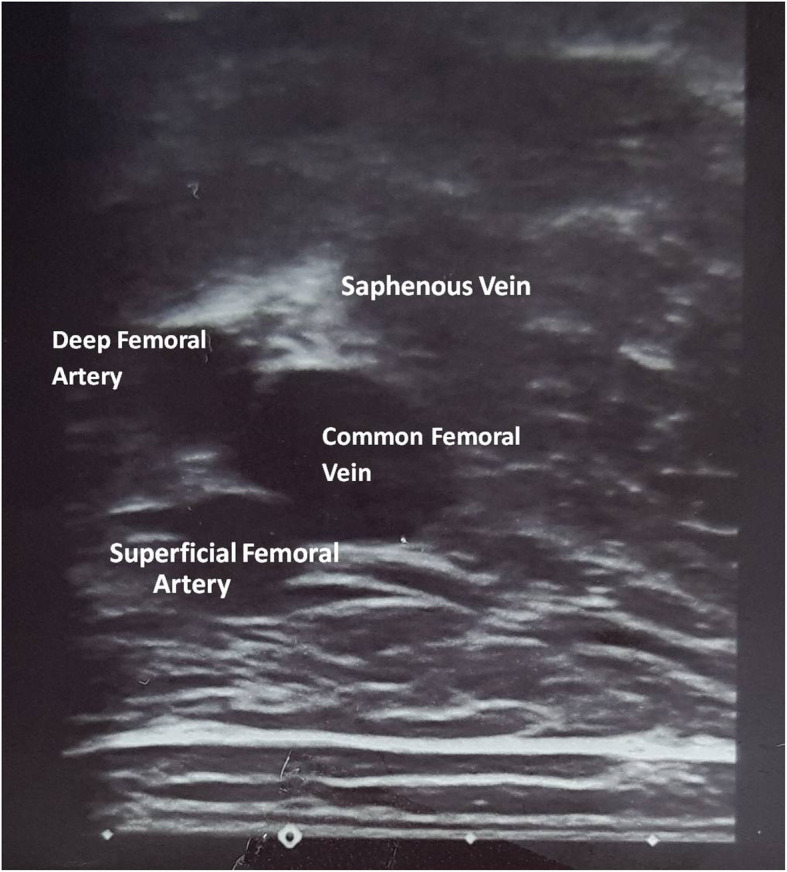 A case report of greater saphenous vein thrombosis in a patient with coronavirus (COVID-19) infection.