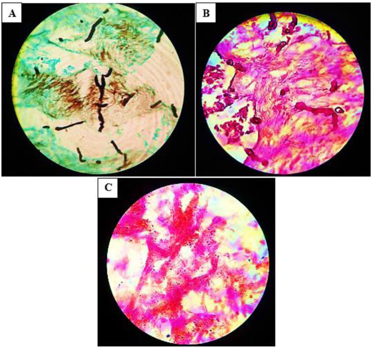 First report of chronic invasive fungal rhinosinusitis in a patient with ovarian cancer caused by <i>Didymella pedeiae</i> and successful treatment with voriconazole: A case report.