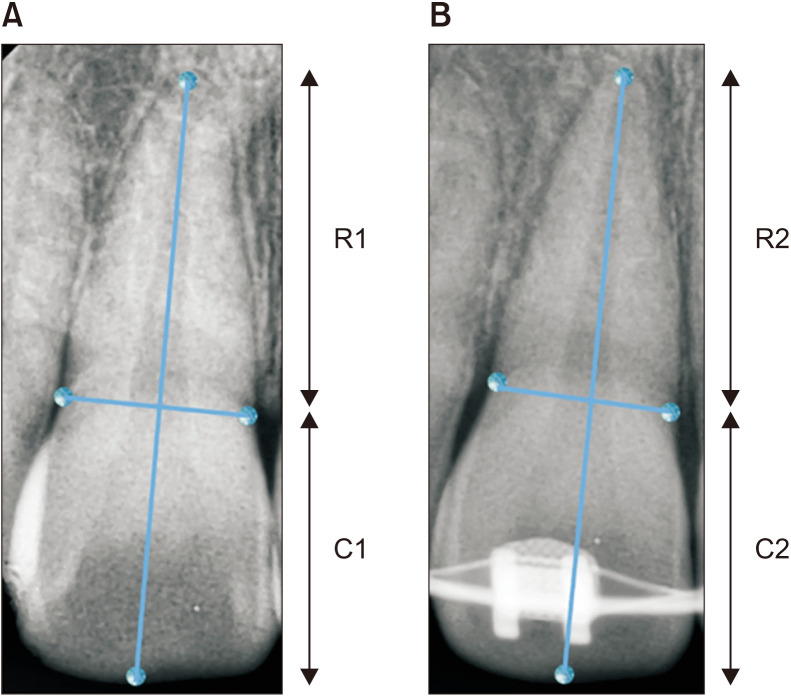 Effect of micro-osteoperforations on external apical root resorption: A randomized controlled trial.