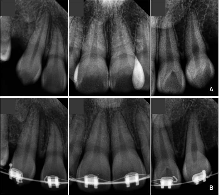 Effect of micro-osteoperforations on external apical root resorption: A randomized controlled trial.