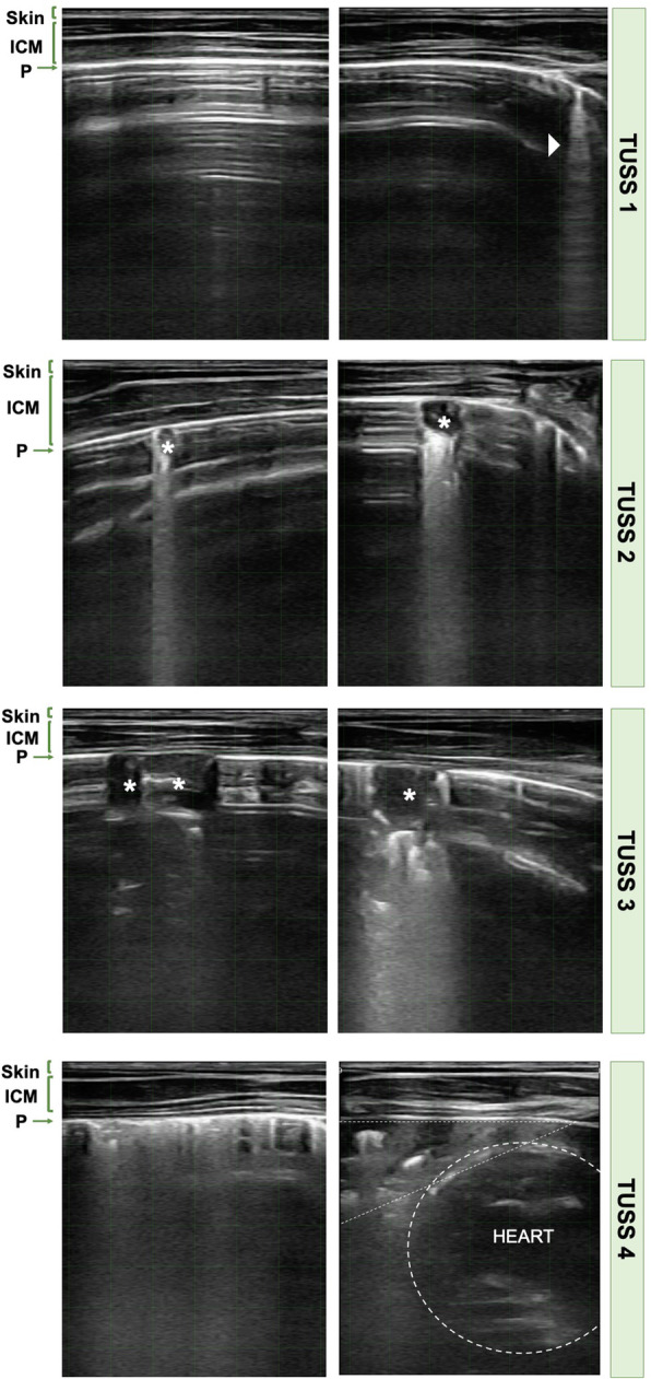 Association between clinical respiratory signs, lung lesions detected by thoracic ultrasonography and growth performance in pre-weaned dairy calves.