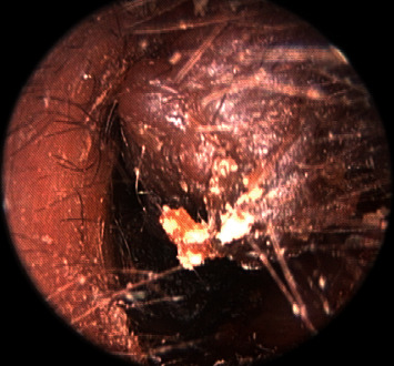 Melanocytic Nevus in the External Auditory Canal with Keratin Accumulation.