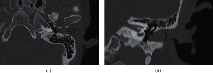 Melanocytic Nevus in the External Auditory Canal with Keratin Accumulation.