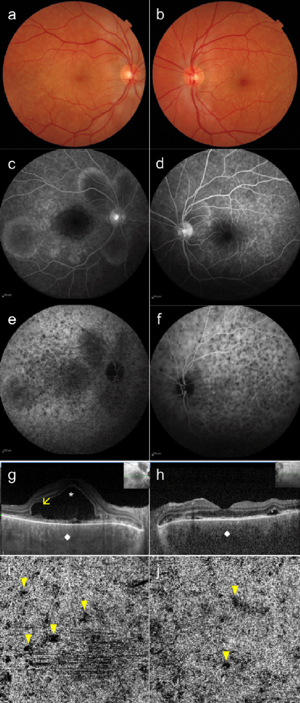 Role of optical coherence tomography angiography in Vogt-Koyanagi-Harada disease.