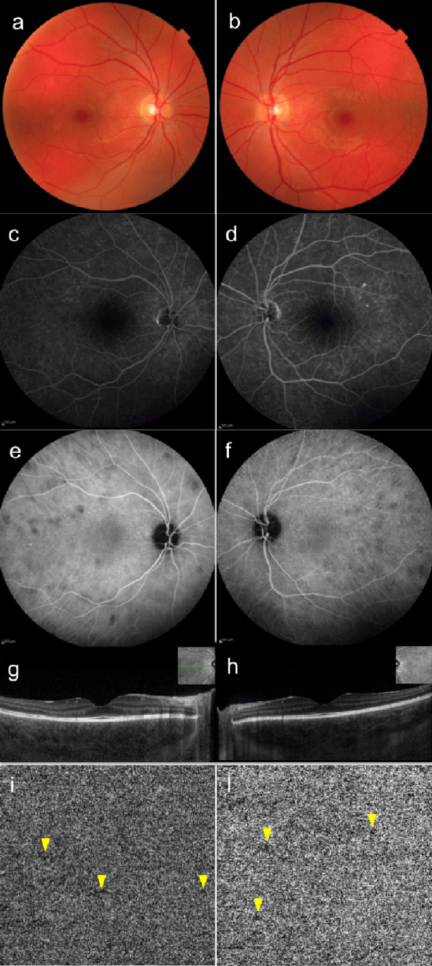 Role of optical coherence tomography angiography in Vogt-Koyanagi-Harada disease.