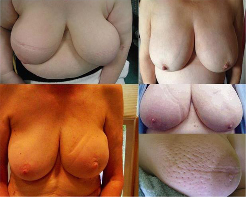 Breast edema, from diagnosis to treatment: state of the art.