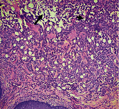 Polymicrobial Necrotizing Fasciitis in a Dog: The Involvement of <i>Macrococcus caseolyticus</i>, <i>Proteus mirabilis</i>, and <i>Escherichia coli</i>.