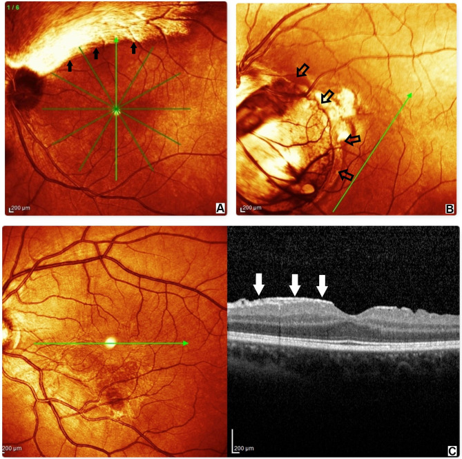 Electrophysiological Study of Visual Pathways in Nevoid Basal Cell Carcinoma Syndrome Patients.