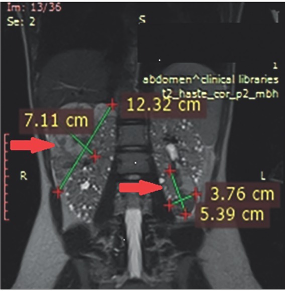 Bilateral Renal Angiomyolipomas and Subependymal Giant Cell Astrocytoma Associated with Tuberous Sclerosis Complex: a Case Report and Review of The Literature.