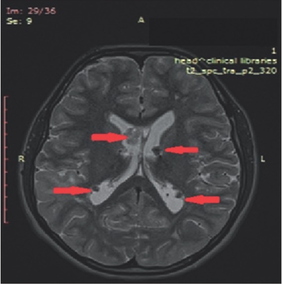 Bilateral Renal Angiomyolipomas and Subependymal Giant Cell Astrocytoma Associated with Tuberous Sclerosis Complex: a Case Report and Review of The Literature.