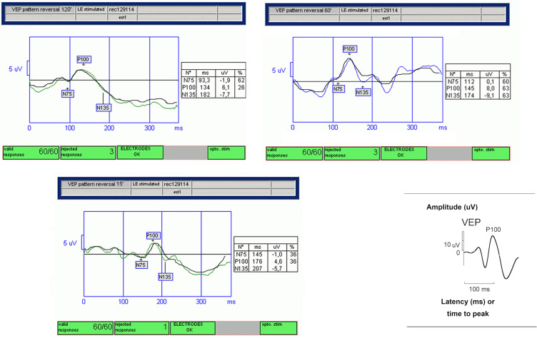 Electrophysiological Study of Visual Pathways in Nevoid Basal Cell Carcinoma Syndrome Patients.