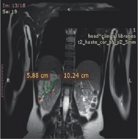 Bilateral Renal Angiomyolipomas and Subependymal Giant Cell Astrocytoma Associated with Tuberous Sclerosis Complex: a Case Report and Review of The Literature.