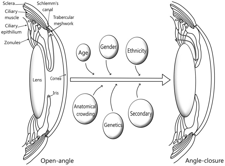 Updates on Genes and Genetic Mechanisms Implicated in Primary Angle-Closure Glaucoma.