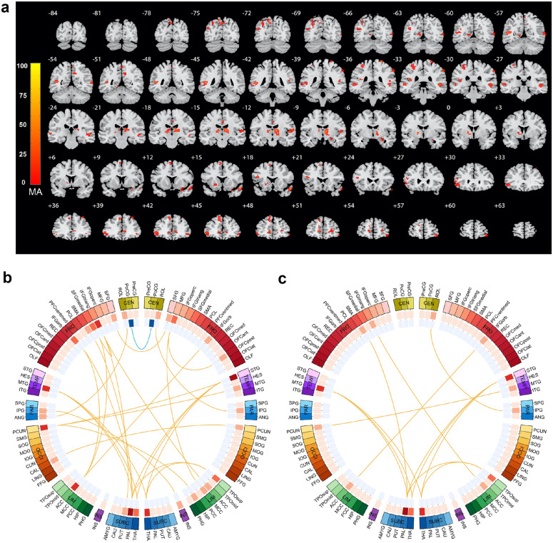 The genetic determinants of language network dysconnectivity in drug-naïve early stage schizophrenia.