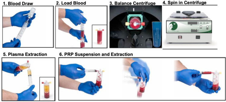 The Use of Autologous Protein Solution (Pro-Stride<sup>®</sup>) and Leukocyte-Rich Platelet-Rich Plasma (Restigen<sup>®</sup>) in Canine Medicine.