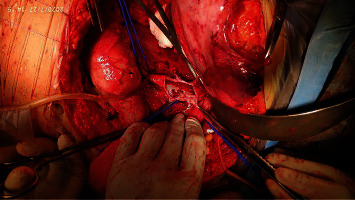 Renal Metastasis of Osteosarcoma with IVC Thrombus.