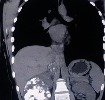 Renal Metastasis of Osteosarcoma with IVC Thrombus.