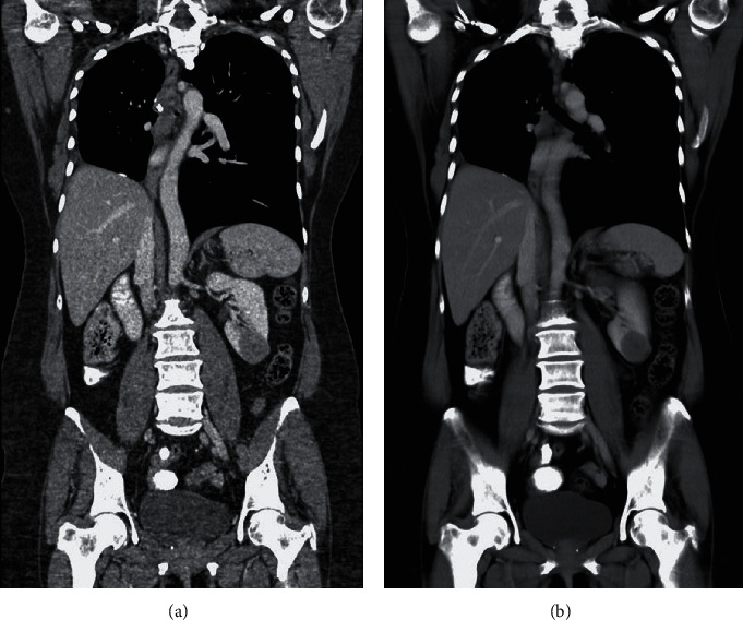 Solitary Renal Metastasis Arising from a Pulmonary Adenoid Cystic Carcinoma: A Case Report and Review of the Literature.