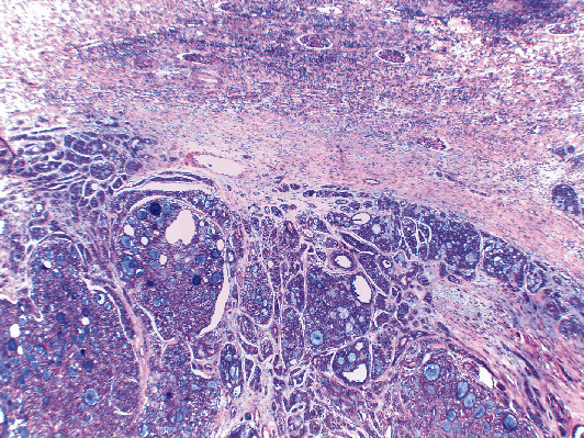 Solitary Renal Metastasis Arising from a Pulmonary Adenoid Cystic Carcinoma: A Case Report and Review of the Literature.