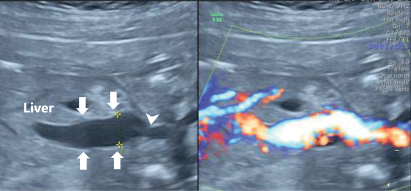 Severe Consumptive Coagulopathy in an Extremely-Low-Birth-Weight Infant with Intra-Abdominal Umbilical Vein Varix: A Case Report.