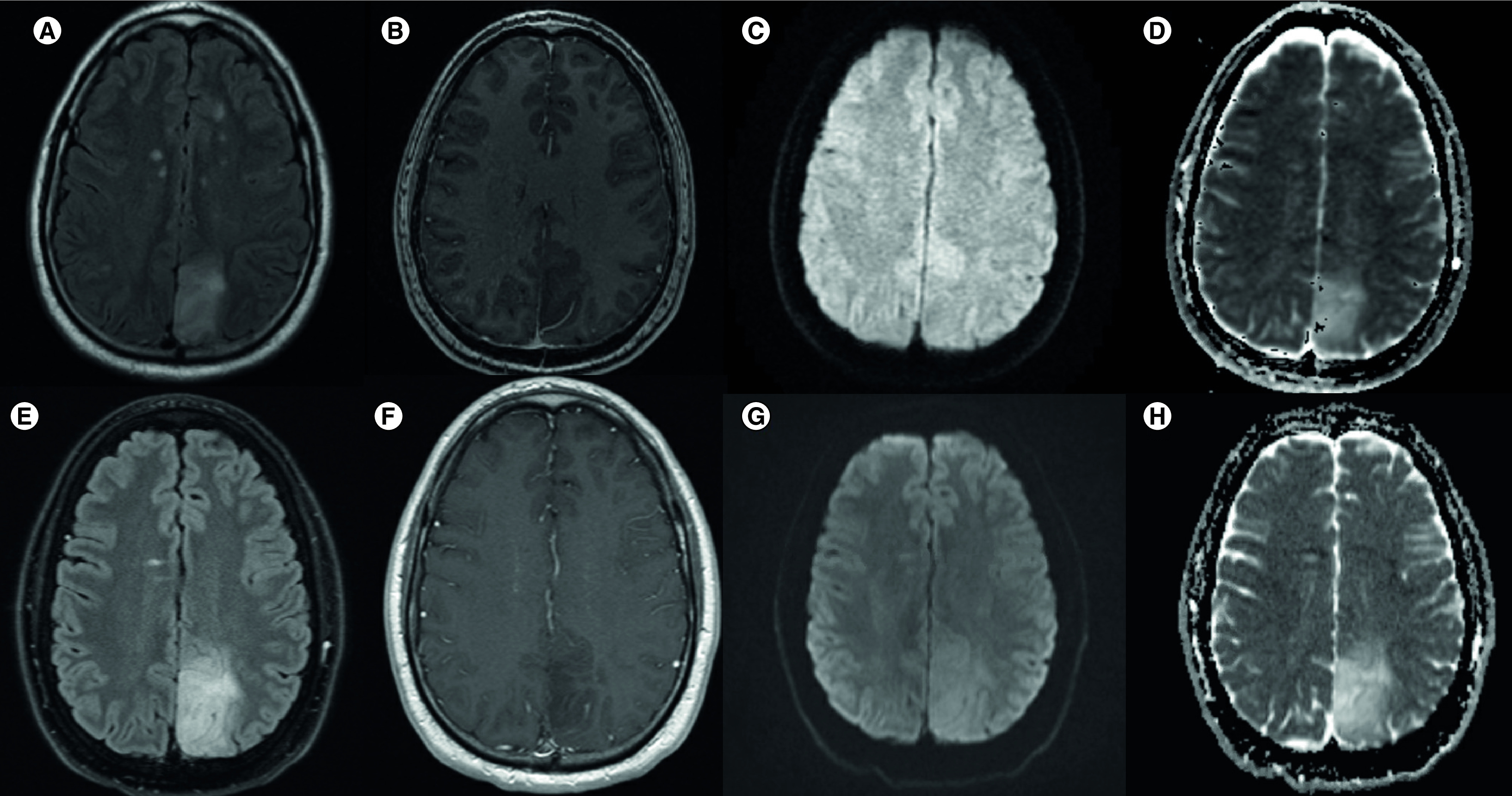 When tumefactive demyelination is truly a tumor: case report of a radiographic misdiagnosis.