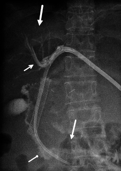 Refractory Biliary Catheter Leak Corrected by a Hybrid Closed Loop Catheter-Pump System.