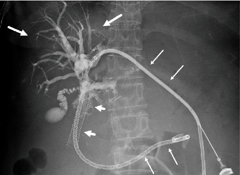 Refractory Biliary Catheter Leak Corrected by a Hybrid Closed Loop Catheter-Pump System.