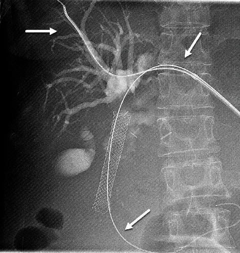 Refractory Biliary Catheter Leak Corrected by a Hybrid Closed Loop Catheter-Pump System.