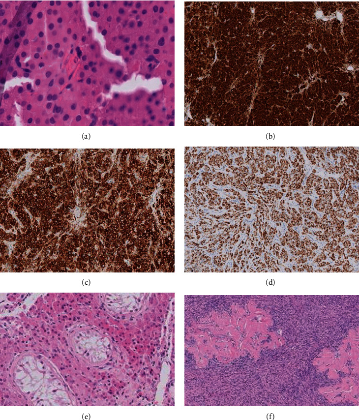 Leydig Cell Tumor in a Patient with 46,XX Disorder of Sex Development (DSD), Ovotesticular: A Case Report and a Review of the Literature.