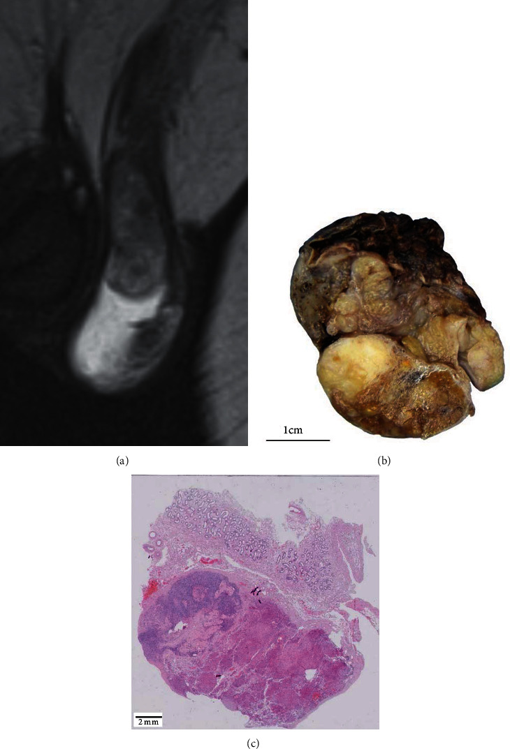 Leydig Cell Tumor in a Patient with 46,XX Disorder of Sex Development (DSD), Ovotesticular: A Case Report and a Review of the Literature.