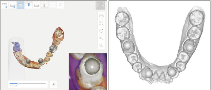 Full-arch accuracy of five intraoral scanners: <i>In vivo</i> analysis of trueness and precision.