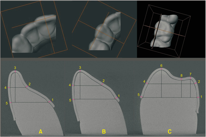 Micro-computed tomography evaluation of general trends in aligner thickness and gap width after thermoforming procedures involving six commercial clear aligners: An <i>in vitro</i> study.