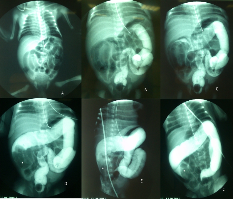 A rare cause of neonatal intussusception. Considering it might reduce the mortality. A case report and a review of the literature