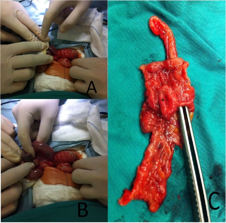 A rare cause of neonatal intussusception. Considering it might reduce the mortality. A case report and a review of the literature